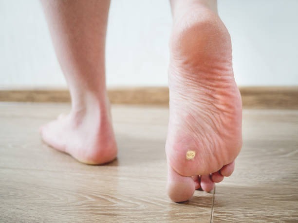 Corns foot care photograph