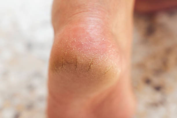 Cracked heels foot care photograph