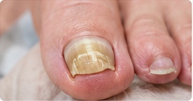 Fungal nails foot care photograph