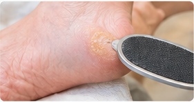 Hard skin & callus foot care photograph